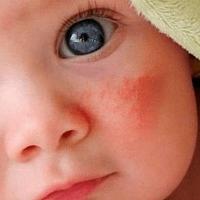 Шершавое пятно на коже у ребенка
