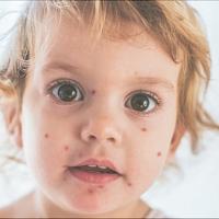 Скарлатина у детей в 3 года: признаки и лечение